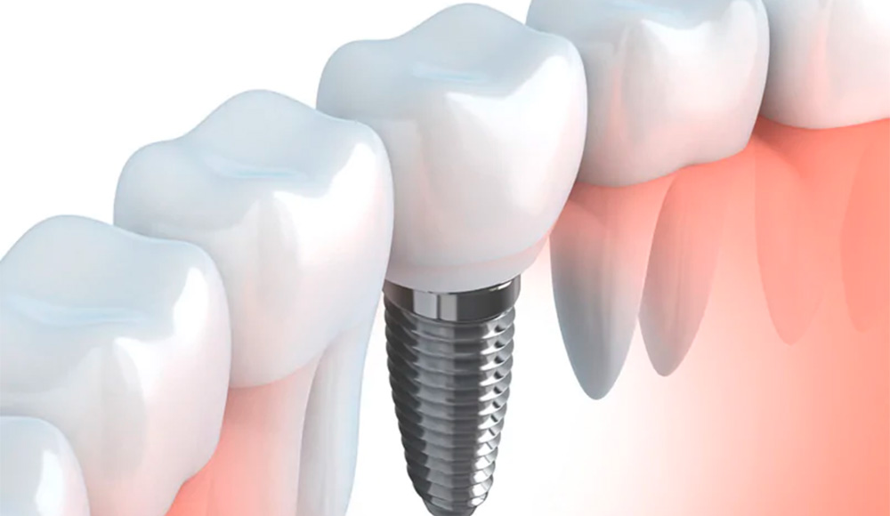 Implante Dentário